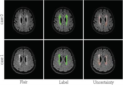 Ensemble learning via supervision augmentation for white matter hyperintensity segmentation